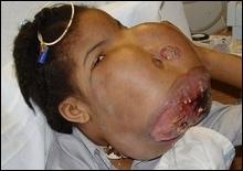 Уникальная операция в США: девочке удалили с лица 7-килограммовую опухоль [15.12.2005 15:28]
