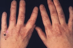 В Петербурге врачи восстановили пальцы девушке с генетическим заболеванием [17.05.2017 16:47]